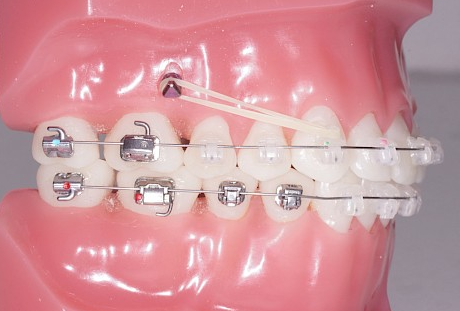 Les mini-vis orthodontiques